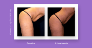 Skin Tightening Treatment Before And After