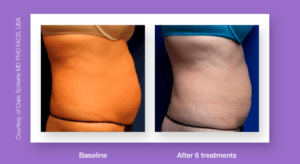 Body Sculpting Treatment Before and After