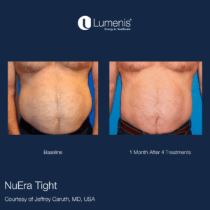 NuEra Tight: Before and After 