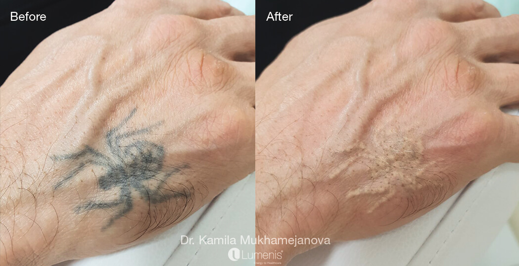 Laser Tattoo Removal Before And After