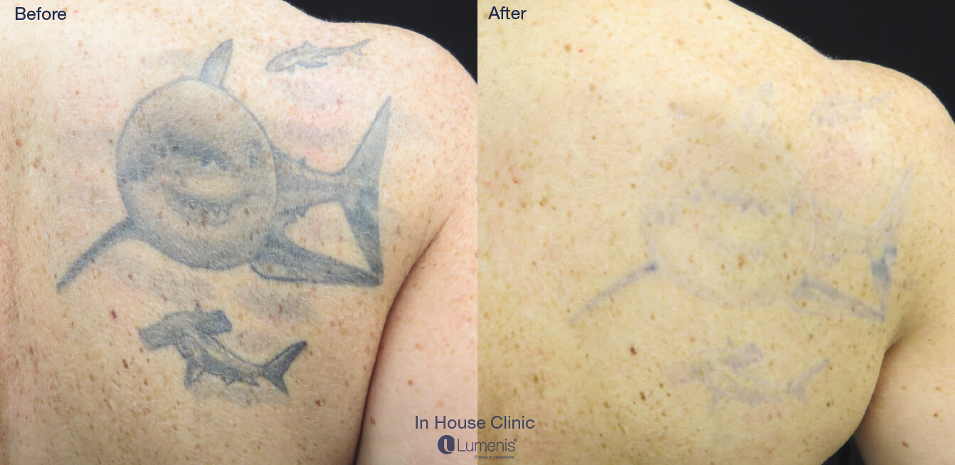 Laser Tattoo Removal Before and After