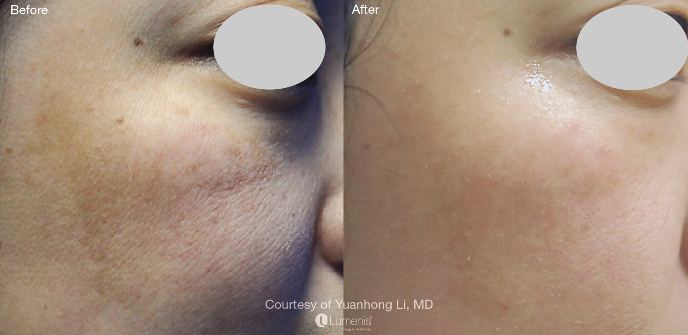 Skin rejuvenation treatment on the face