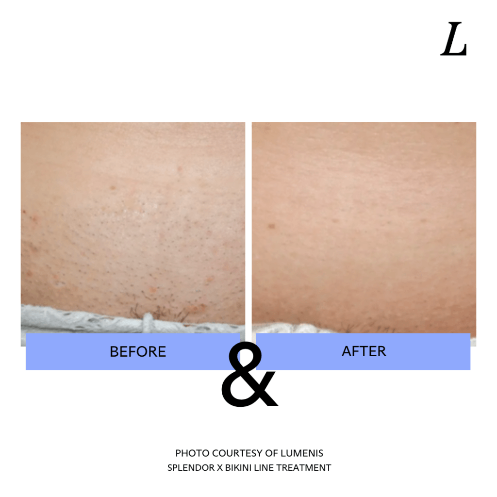 Brazilian Laser Hair Removal Before & After